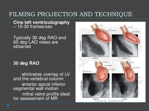 lv gram procedure|Ventriculography (LV Gram) .